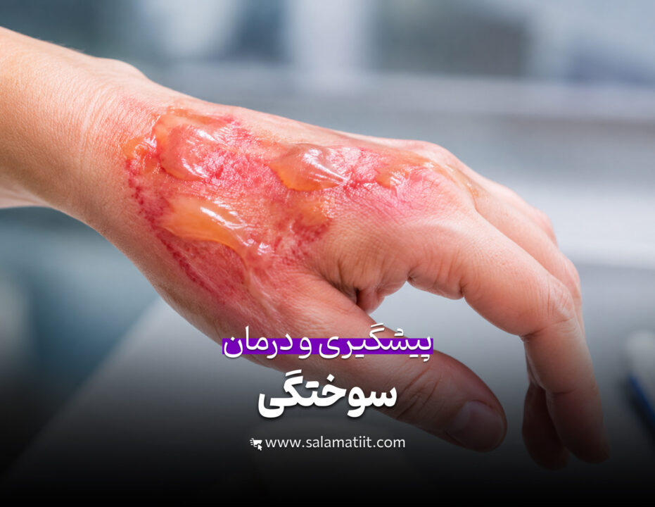 سوختگی